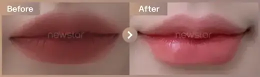 Lip filler: before-and-after comparison at Newstar Clinic