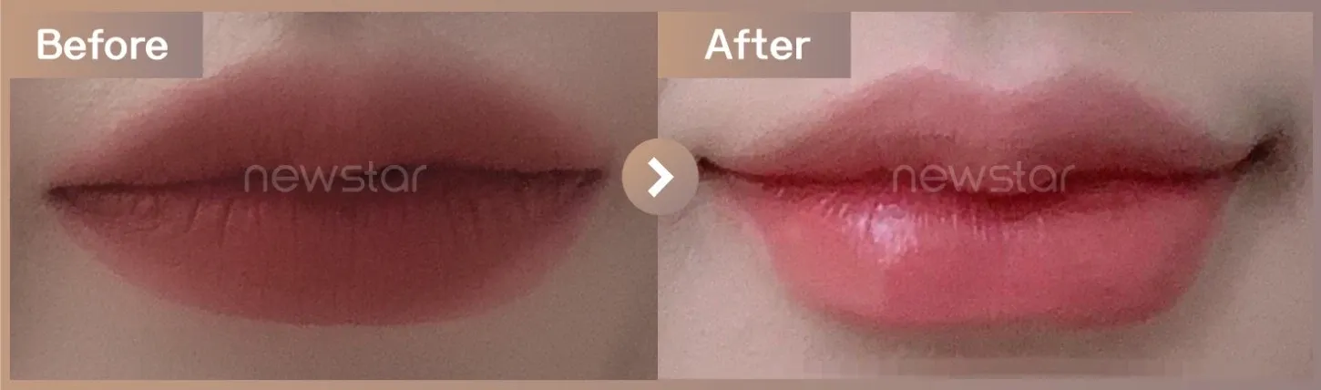 Lip filler before-and-after photos at Newstar Clinic