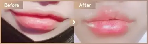 Lip filler: before-and-after comparison at Newstar Clinic