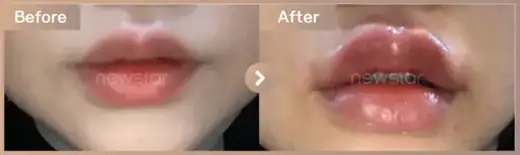 Lip filler: before-and-after comparison at Newstar Clinic