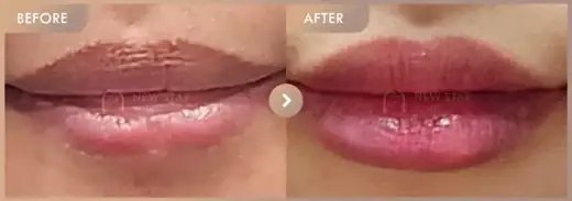 Lip fillers: before-and-after comparison at Newstar Clinic