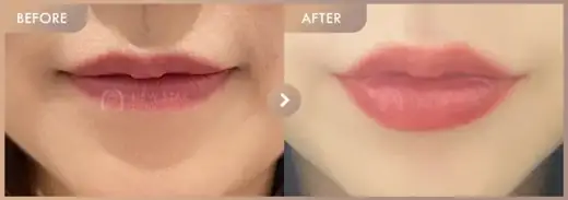 Lip filler: before-and-after comparison at Newstar Clinic