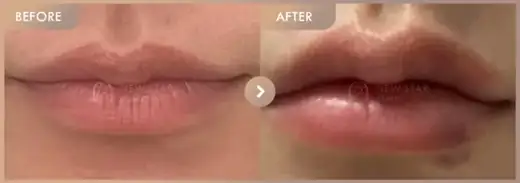 Lip filler: before-and-after comparison at Newstar Clinic