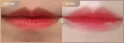 Lip filler: before-and-after comparison at Newstar Clinic