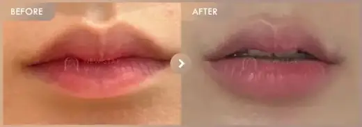 Lip filler: before-and-after comparison at Newstar Clinic