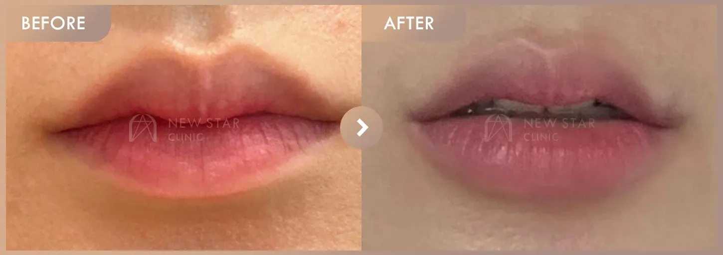 Lip filler before-and-after photos at Newstar Clinic