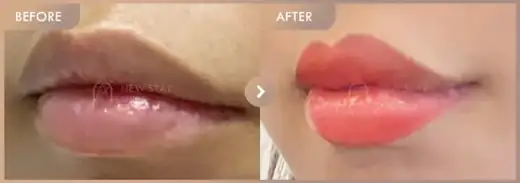 Lip filler: before-and-after comparison at Newstar Clinic