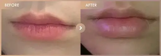 Lip filler: before-and-after comparison at Newstar Clinic