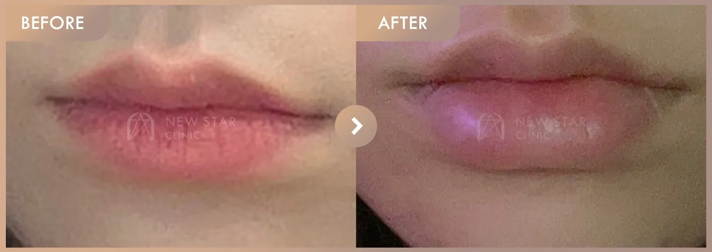 Lip filler before-and-after photos at Newstar Clinic