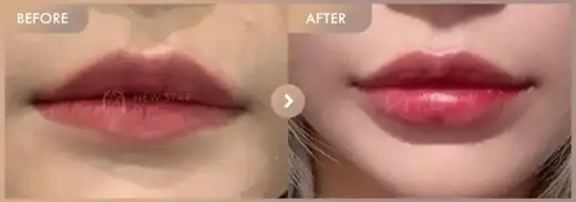 Lip filler: before-and-after comparison at Newstar Clinic
