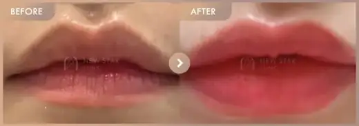 Lip filler: before-and-after comparison at Newstar Clinic