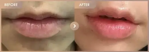 Lip filler: before-and-after comparison at Newstar Clinic