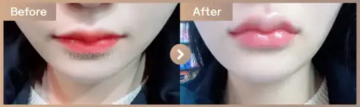 Lip filler: before-and-after comparison at Newstar Clinic