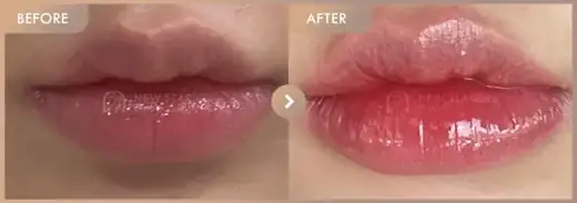 Lip filler: before-and-after comparison at Newstar Clinic
