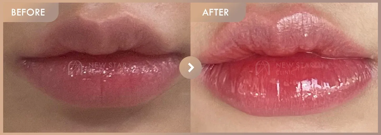 Lip filler before-and-after photos at Newstar Clinic