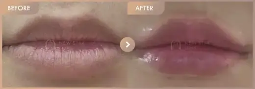 Lip filler: before-and-after comparison at Newstar Clinic