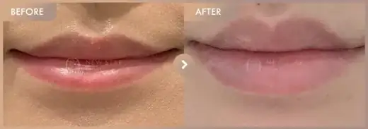 Lip filler: before-and-after comparison at Newstar Clinic