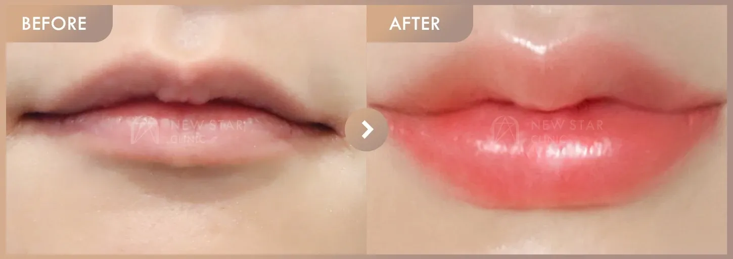 Lip filler before-and-after photos at Newstar Clinic