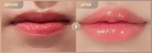 Lip filler: before-and-after comparison at Newstar Clinic