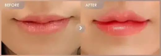 Lip filler: before-and-after comparison at Newstar Clinic