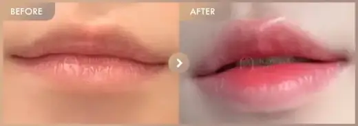 Lip filler: before-and-after comparison at Newstar Clinic