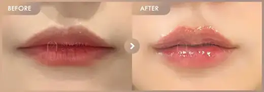 Lip filler: before-and-after comparison at Newstar Clinic