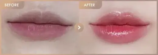 Lip filler: before-and-after comparison at Newstar Clinic