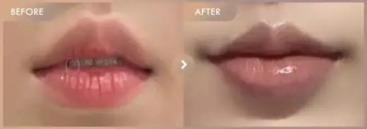 Lip filler: before-and-after comparison at Newstar Clinic