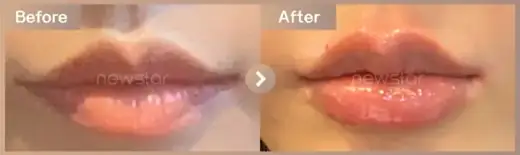 Lip filler: before-and-after comparison at Newstar Clinic