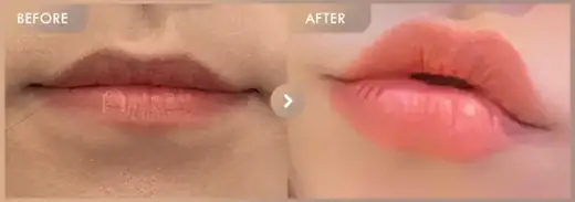 Lip filler: before-and-after comparison at Newstar Clinic