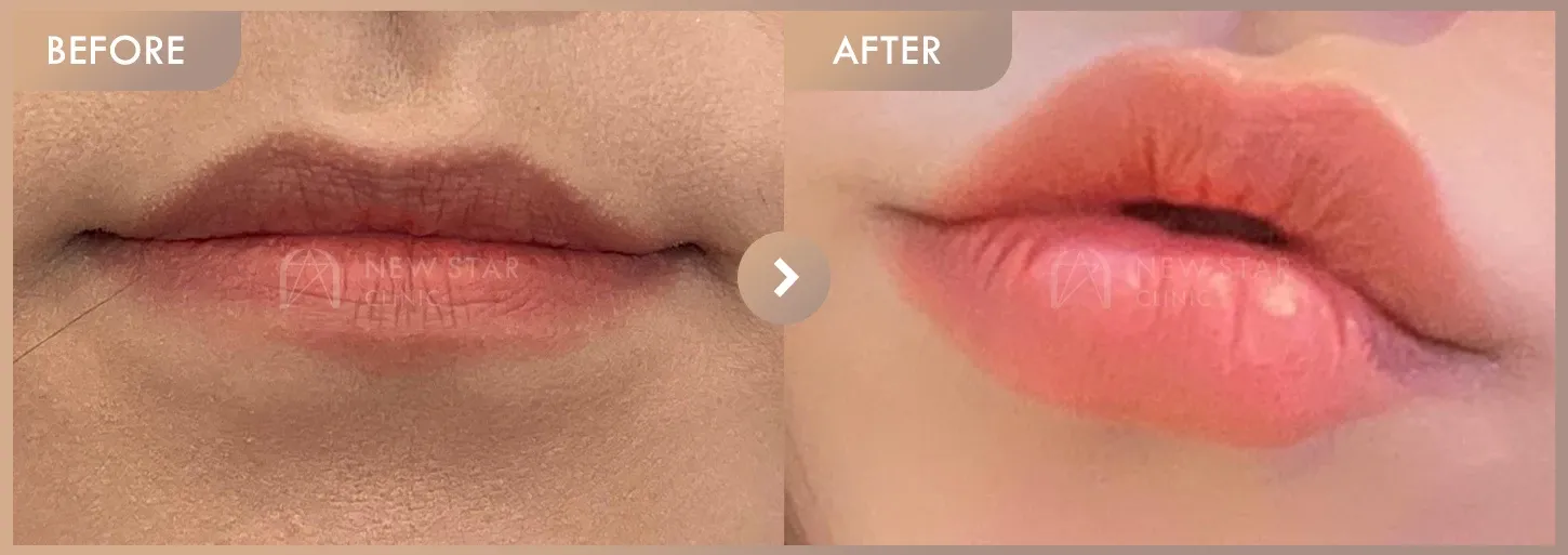 Lip filler before-and-after photos at Newstar Clinic
