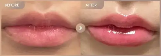 Lip filler: before-and-after comparison at Newstar Clinic