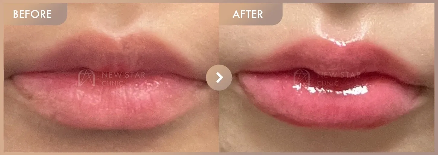 Lip filler before-and-after photos at Newstar Clinic