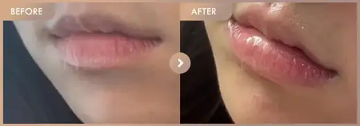 Lip filler: before-and-after comparison at Newstar Clinic