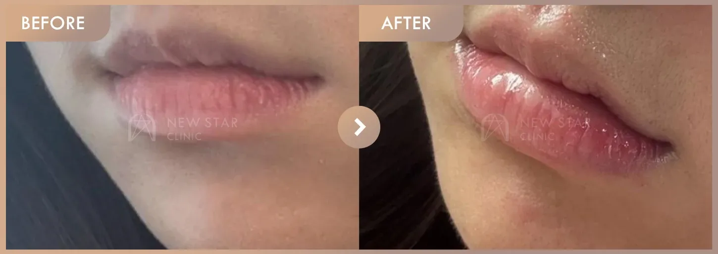 Lip filler before-and-after photos at Newstar Clinic