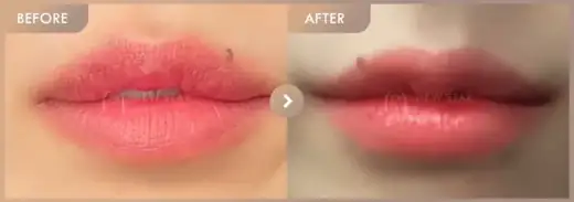 Lip filler: before-and-after comparison at Newstar Clinic