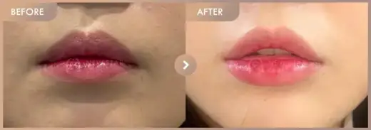 Lip filler: before-and-after comparison at Newstar Clinic