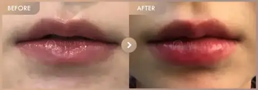 Lip filler: before-and-after comparison at Newstar Clinic