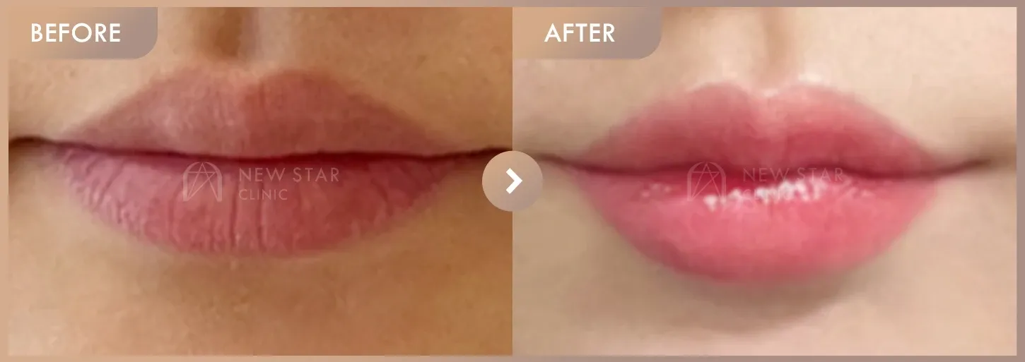 Lip filler before-and-after photos at Newstar Clinic