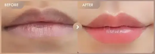 Lip filler: before-and-after comparison at Newstar Clinic