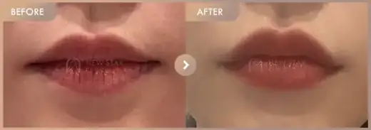 Lip filler: before-and-after comparison at Newstar Clinic
