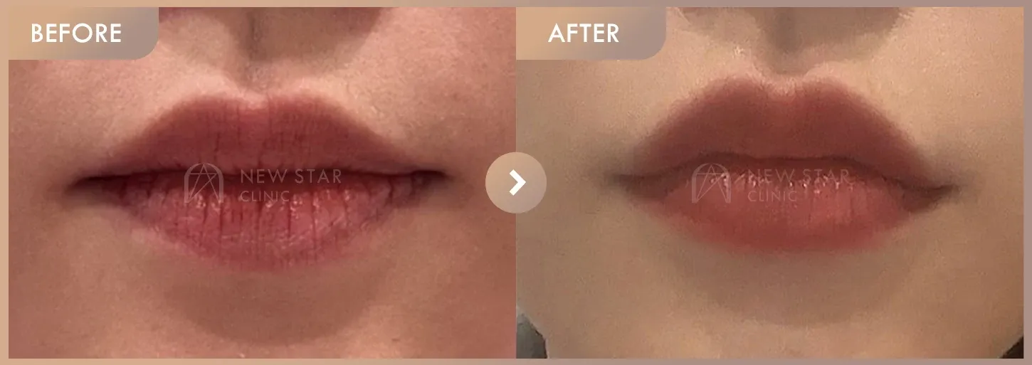 Lip filler before-and-after photos at Newstar Clinic