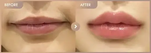 Lip filler: before-and-after comparison at Newstar Clinic
