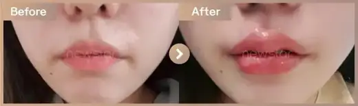 Lip filler: before-and-after comparison at Newstar Clinic