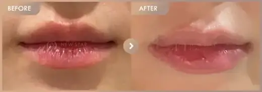 Lip filler: before-and-after comparison at Newstar Clinic