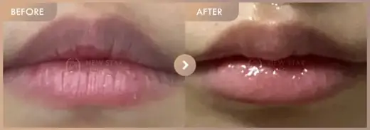 Lip filler: before-and-after comparison at Newstar Clinic