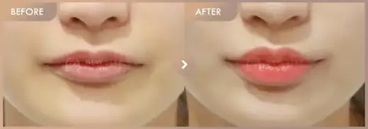 Lip filler: before-and-after comparison at Newstar Clinic