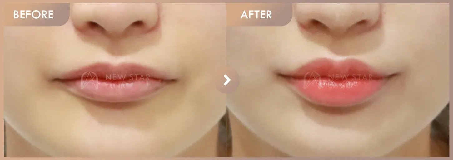Lip filler before-and-after photos at Newstar Clinic