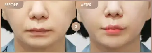 Lip filler + Chin filler: before-and-after comparison at Newstar Clinic