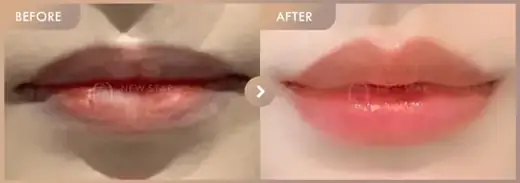 Lip filler: before-and-after comparison at Newstar Clinic